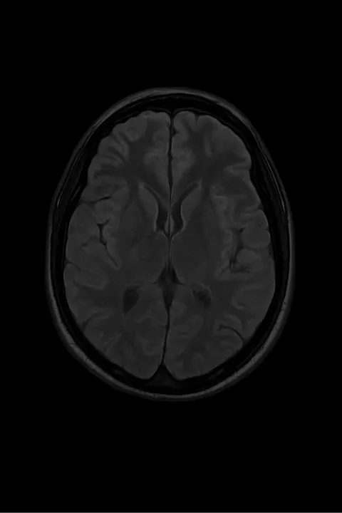 Cerebrospinal Fluid (CSF)