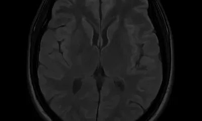 Human Cerebrospinal Fluid (CSF) - Spinal Fluid, Synthetic CSF ...